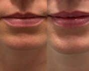 Experience fuller, beautifully shaped lips with lip filler before and after results at Columbine Aesthetics. Book your consultation now for personalized results.