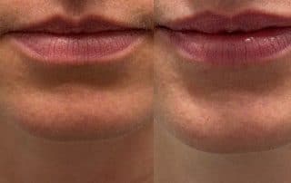 Experience fuller, beautifully shaped lips with lip filler before and after results at Columbine Aesthetics. Book your consultation now for personalized results.