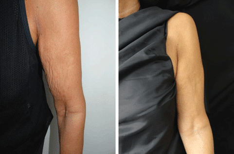 Hyperdilute Radiesse