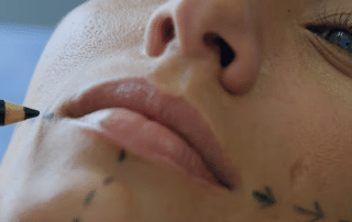hyaluronic acid dermal fillers for lip augmentation at Columbine Aesthetics, enhancing natural volume and shape. Call (720) 504-4407 to learn more.