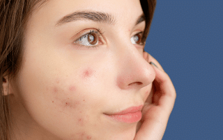 Learn how the exfoliating effects of VI Peels at Columbine Aesthetics, helping to clear acne and smooth skin. Call (720) 504-4407 for more details.