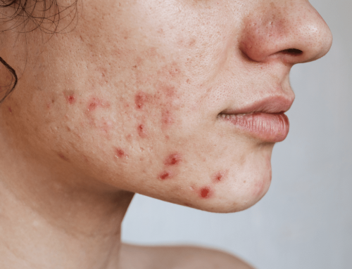 How Many Sessions of Microneedling Are Needed for Scar Reduction?