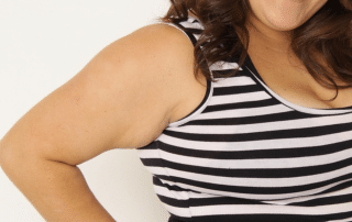 Hyperdilute Radiesse treatment in progress at Columbine Aesthetics, targeting sagging skin on the knees and arms. Call (720) 504-4407 to book your consultation today.