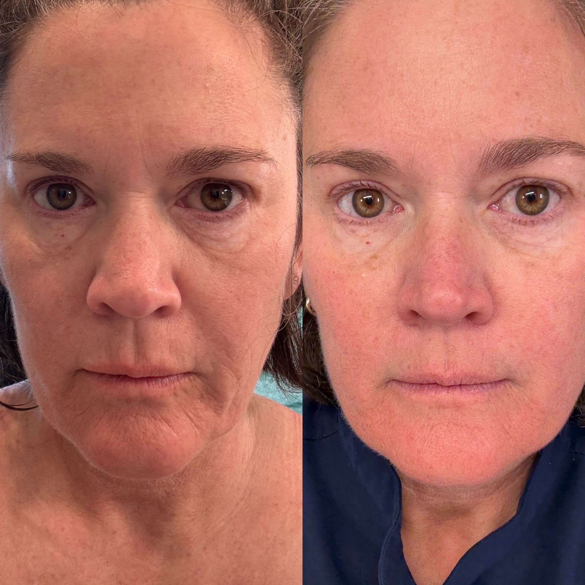 Alastin Skincare Products for anti-aging and skin firming at Columbine Aesthetics. Call (720) 504-4407 to schedule your personalized skincare consultation today.