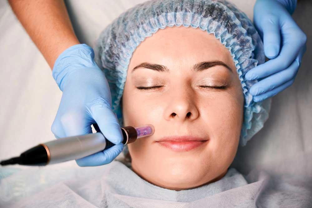 Woman receiving microneedling in Colorado at Columbine Aesthetics to rejuvenate skin and boost collagen naturally.
