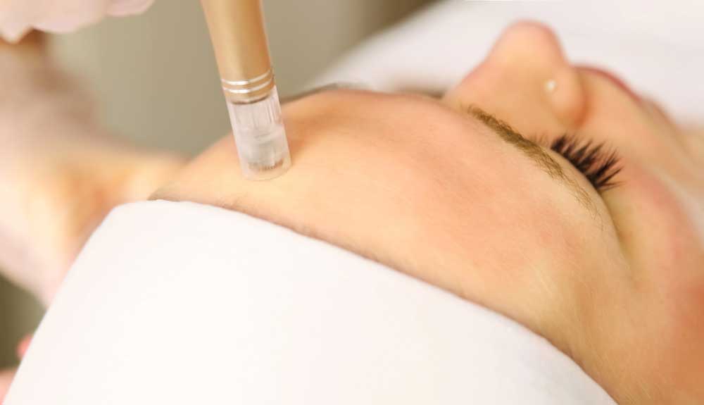 Client receiving microneedling in Littleton, Colorado at Columbine Aesthetics to rejuvenate skin and restore a youthful glow.